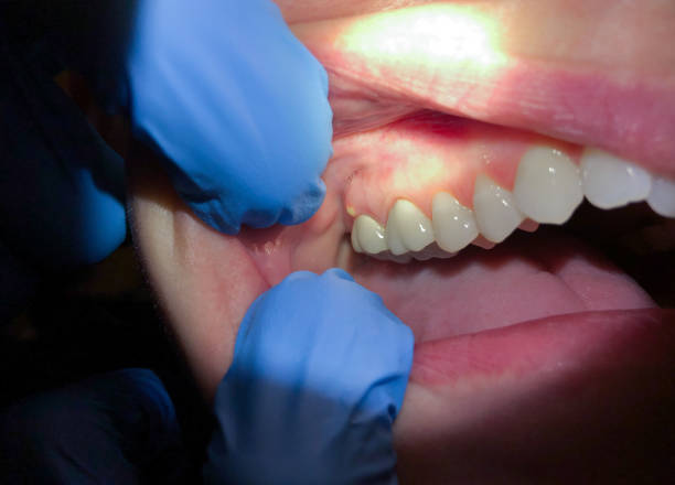 Best Urgent Care for Lost Fillings or Crowns in Dayton, OH