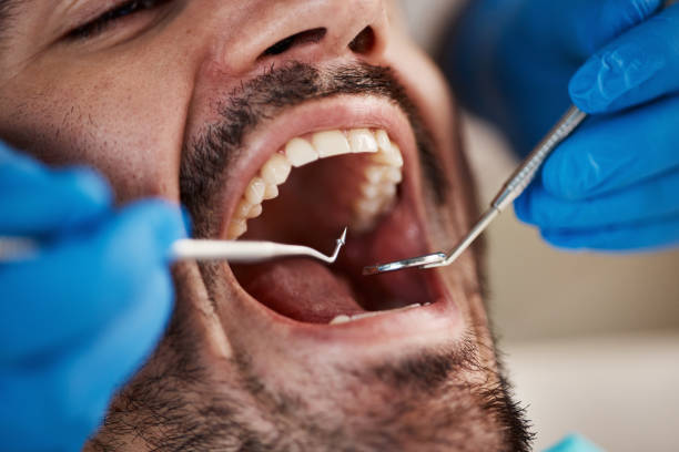 Best Emergency Tooth Extraction in Dayton, OH