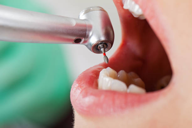 Best Emergency Tooth Extraction in Dayton, OH